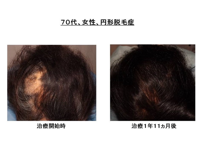 円形脱毛症　病院""